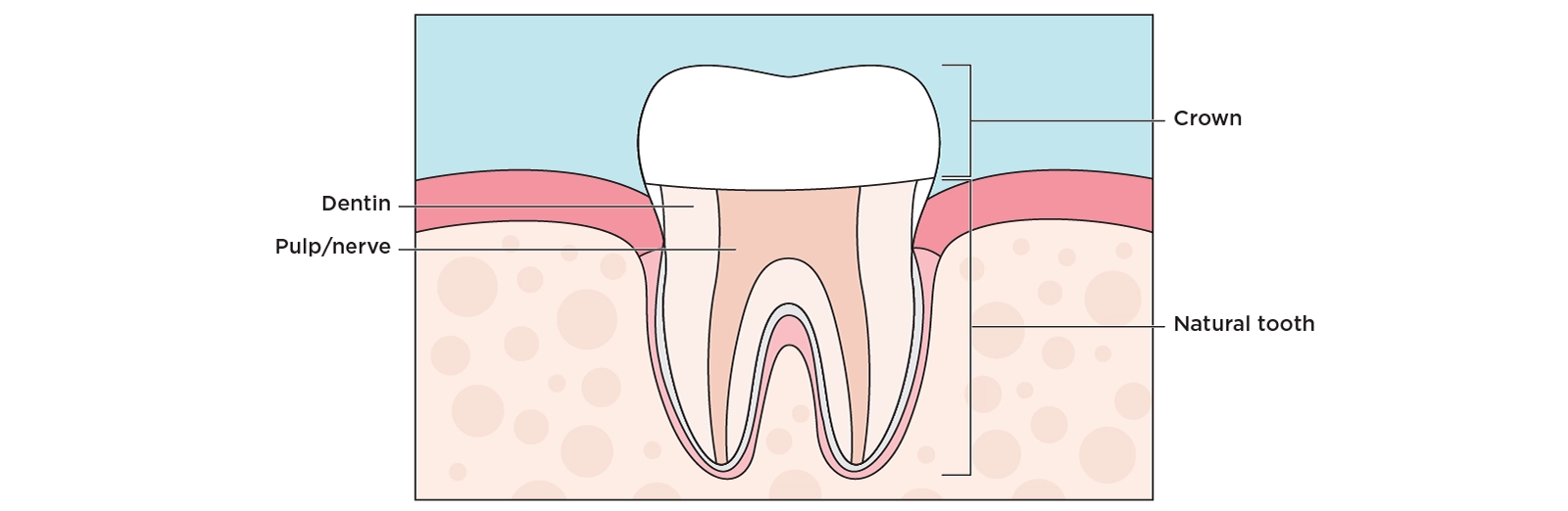 Illustration of a cross section of a tooth showing what part a dental crown covers