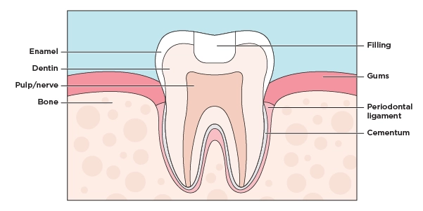 Illustration of a cross section of a tooth showing a filling in the top of a tooth