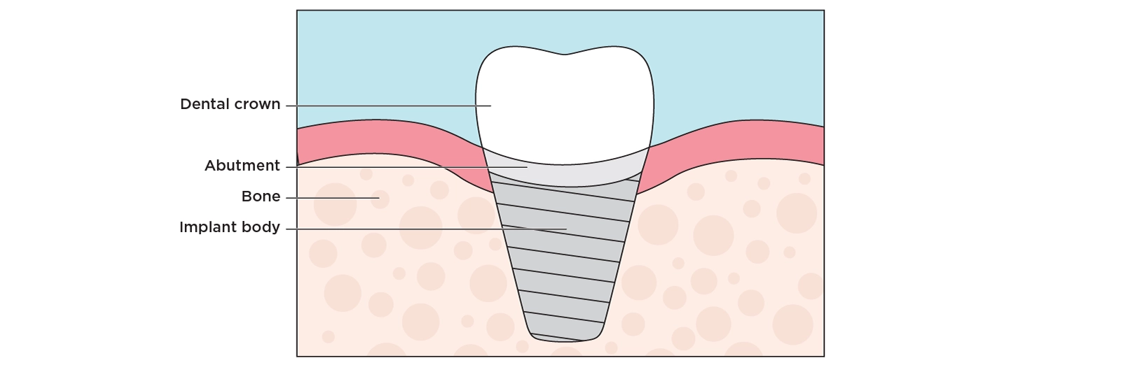 Illustration of a cross section of a jaw showing the dental implant body, abutment, and crown