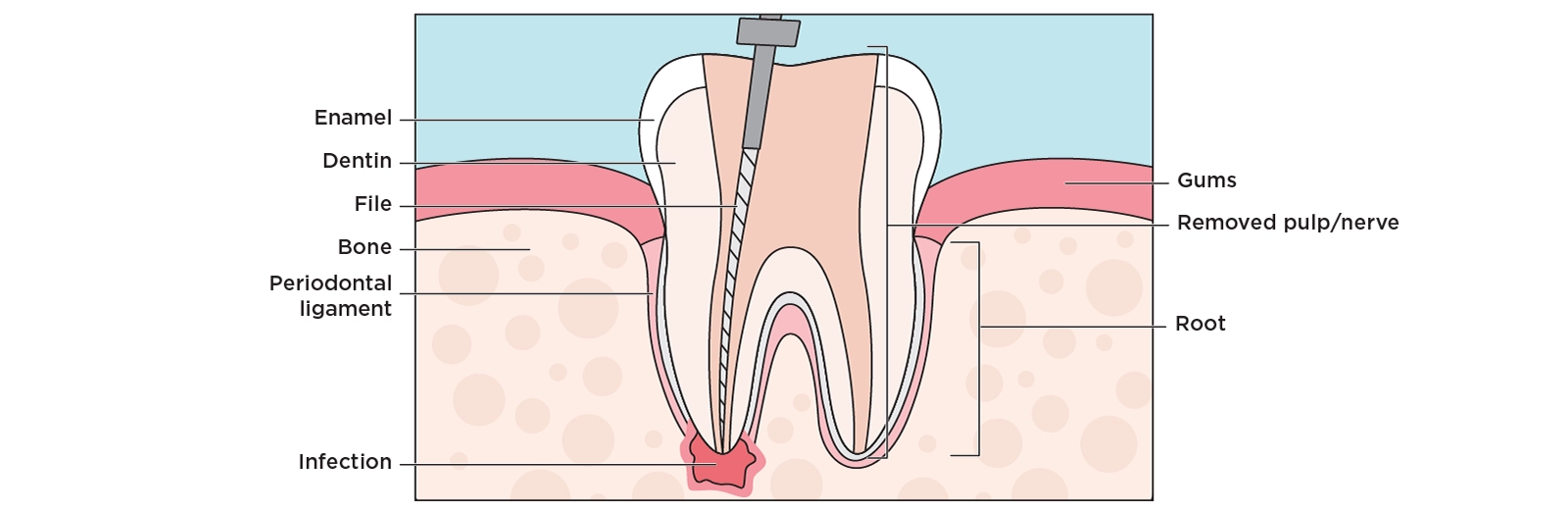 Illustration of a cross section of a tooth showing a root canal procedure to fix an infection