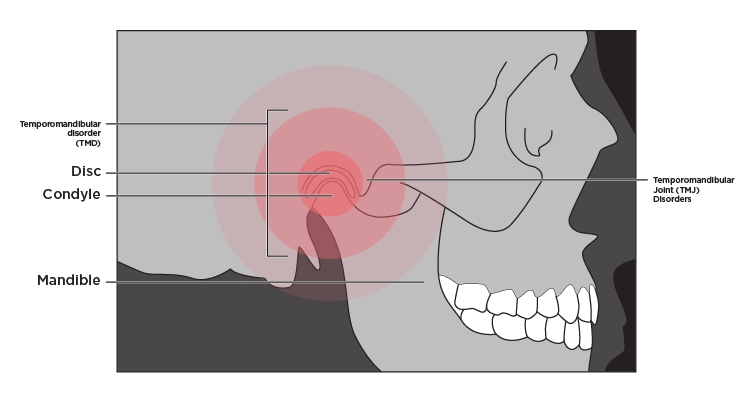 Illustration of a skull showcasing where TMJ and TMD pain occurs