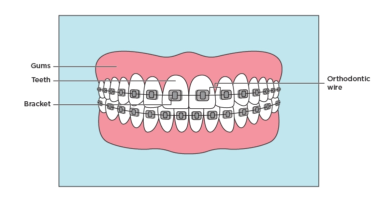 Illustration showing traditional metal braces with the brackets and wires
