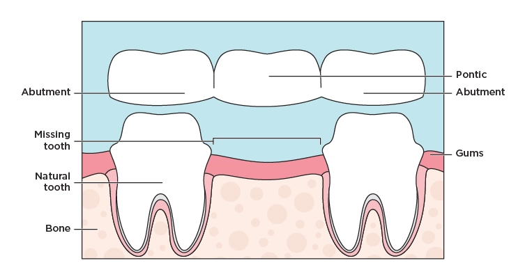 Illustration showing a dental  bridge connecting two teeth