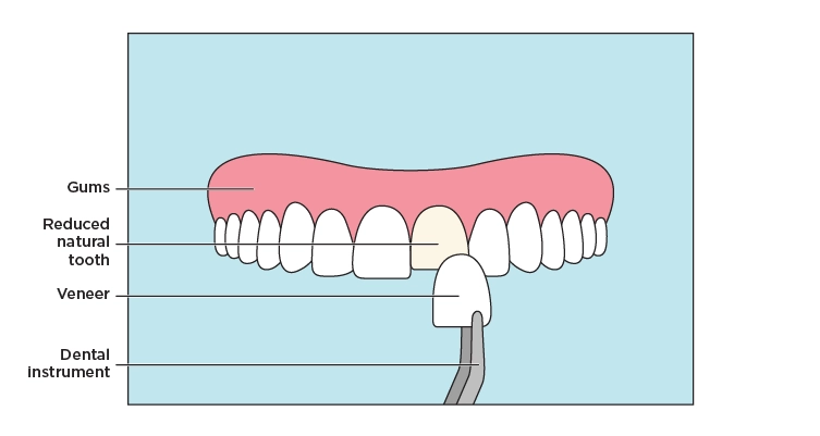 Illustration showing a veneer covering a discolored front tooth