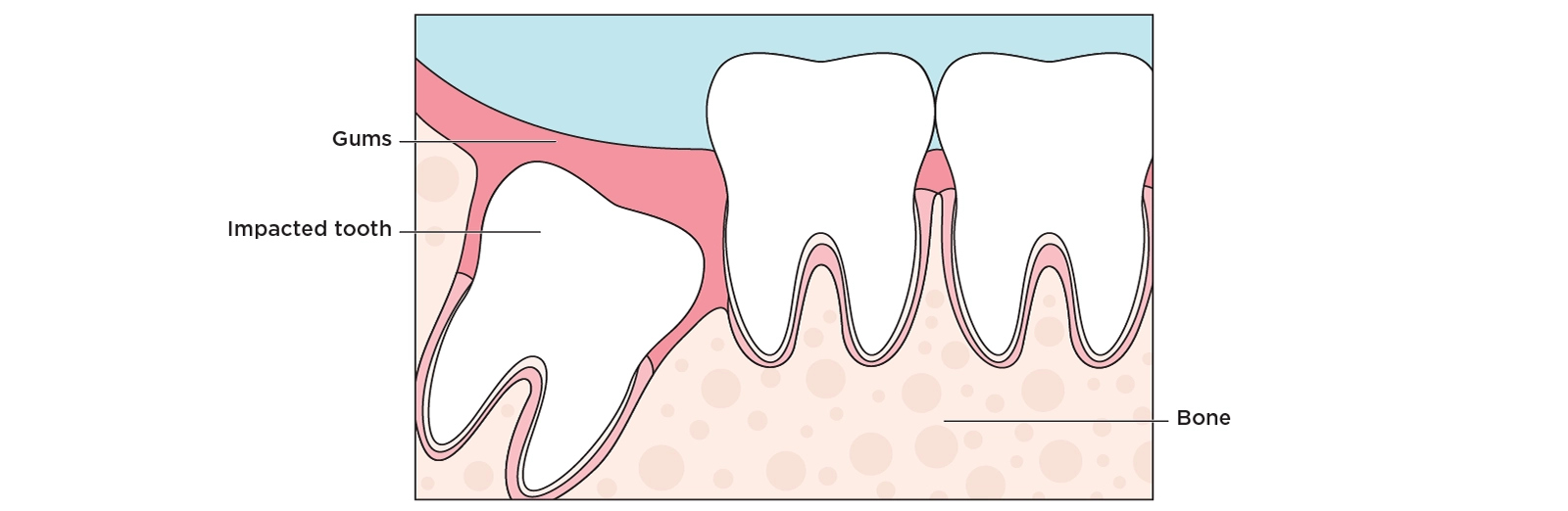 Illustration of a jaw showing the impacted wisdom tooth and why it needs to be removed